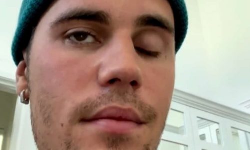 Justin Bieber paralysé de la moitié du visage: il est atteint d’un syndrome rare